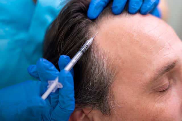 FUE Hair Transplant