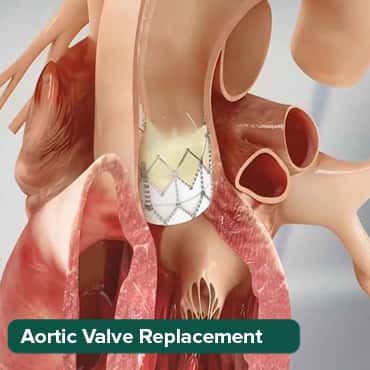 AVR - Open heart