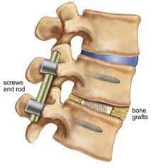 Transforaminal interbody lumbar fusion(TLIF)