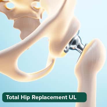Direct Anterior Approach Total Hip Arthroplasty 2 sides, Exclude implants
