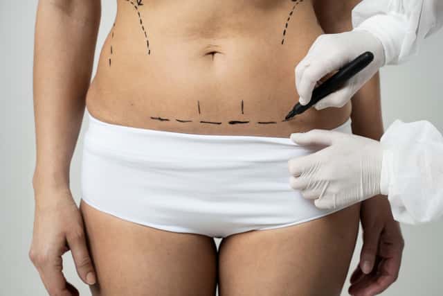 Tummy tuck