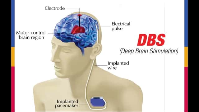 DBS