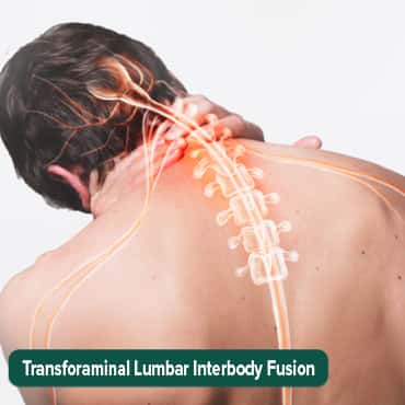 Transforaminal interbody lumbar fusion(TLIF)