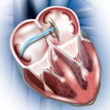 Atrial Septal Defects (ASD) / Ventricular Septal Defects (VSD)