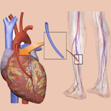 Coronary Artery Bypass Grafting(CABG)