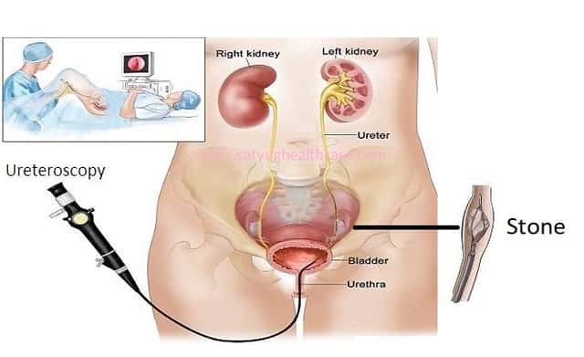 DJ STENTING (BILATERAL)