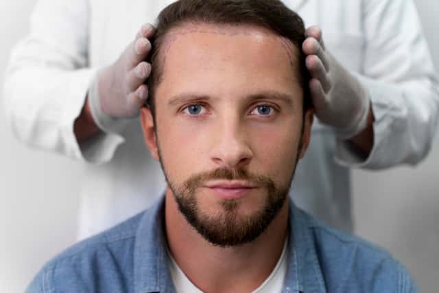 DHI Hair Transplant