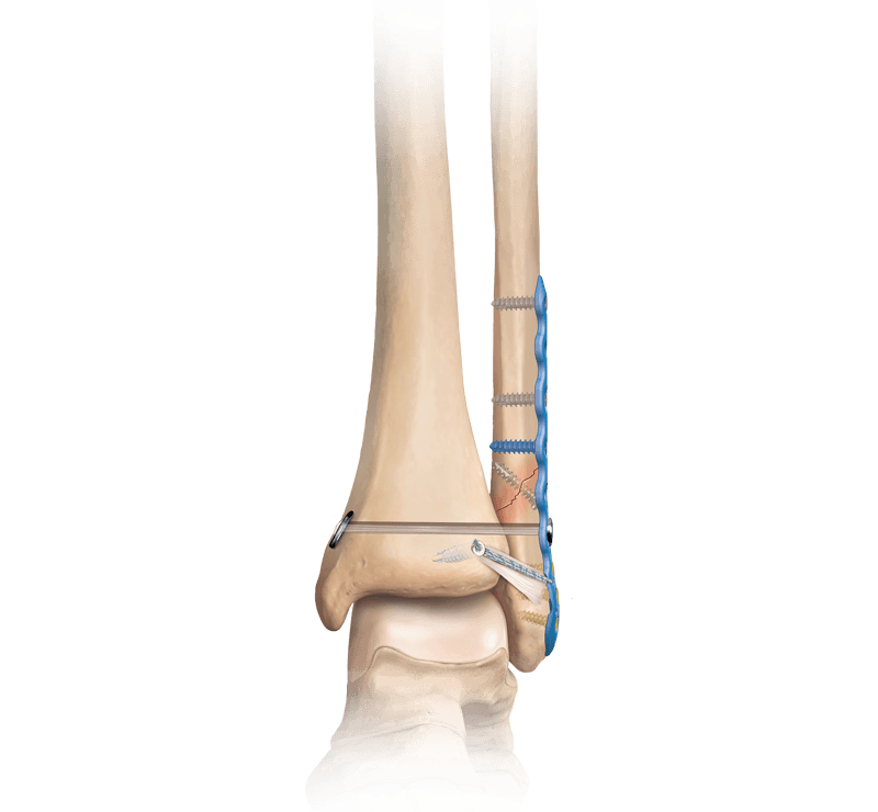 Prcedure Image